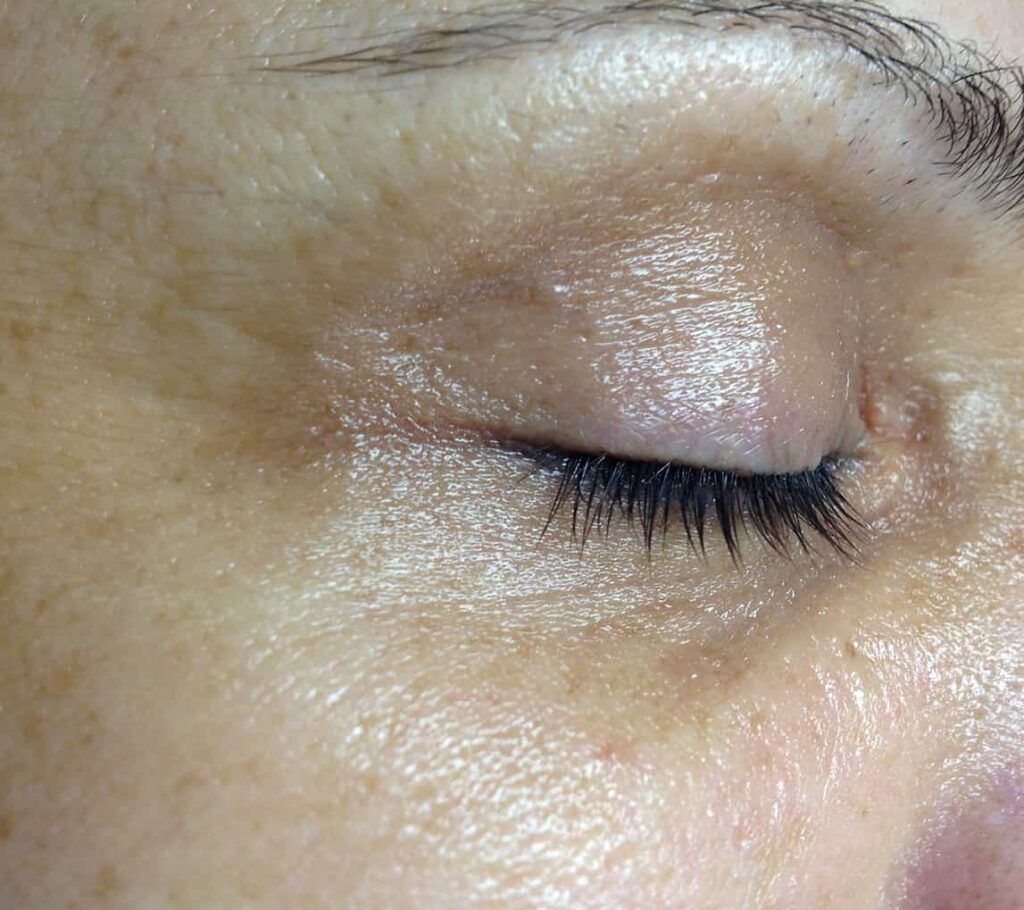 After Gloceren Facial