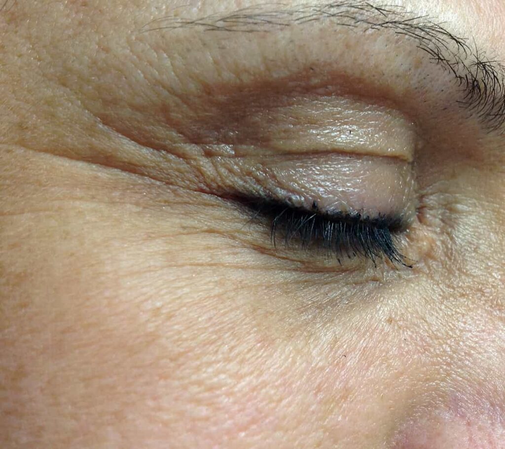 Before Gloceren Facial