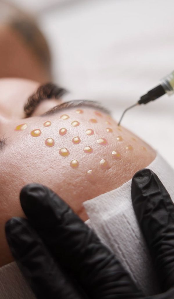 29% tca - no down time chemical peel on face.